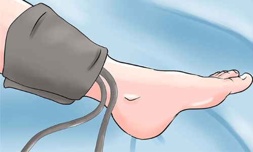 Can Blood Pressure Mniotor Predict Whether Blood Vessels are Blocked?