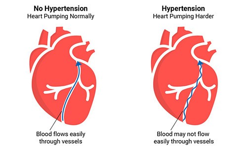 Understanding Types and Subtypes of Hypertension