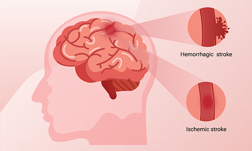How High Blood Pressure Can Lead to Stroke?