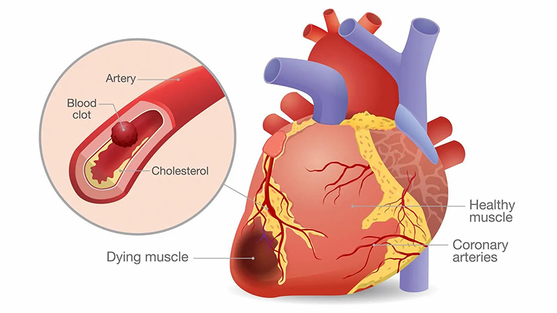 Pangao-The Importance of Blood Pressure Monitoring for COVID-19 Survivors' Long-Term Health (3).jpg