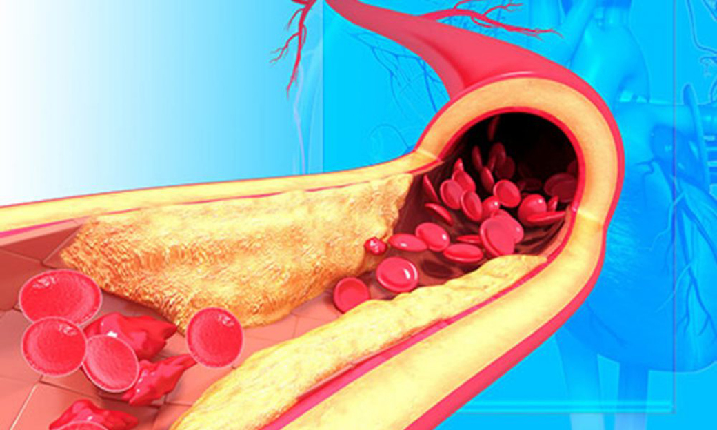 Pangao-Can Stiff Arteries or Severe Hypotension Cause Low Diastolic Blood Pressure (3).jpg